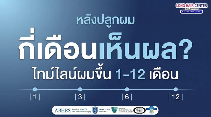 ปลูกผม กี่เดือนเห็นผล? ไทม์ไลน์ผมขึ้น 1–12 เดือน
