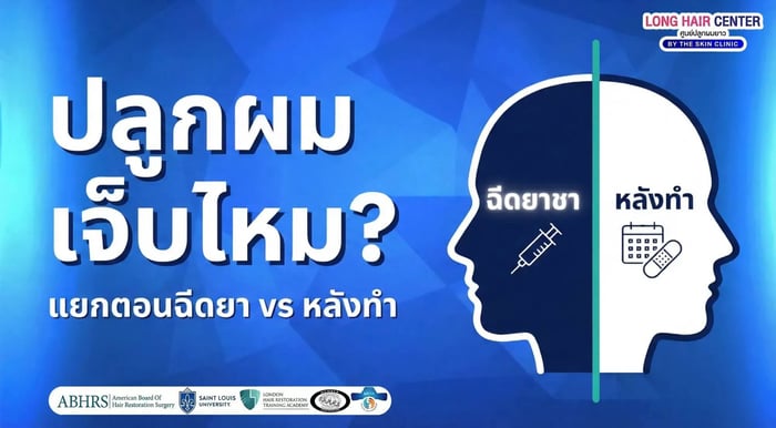 ปลูกผมเจ็บไหม? แยกตอนฉีดยา กับ หลังทำให้ชัด
