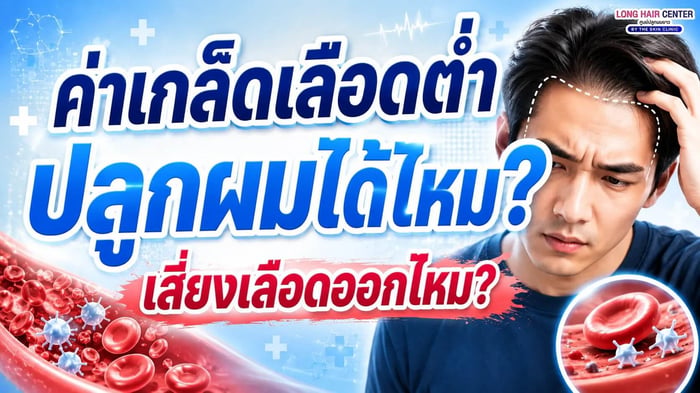 ค่าเกล็ดเลือดต่ำ ปลูกผมได้ไหม? เสี่ยงเลือดออกไหม