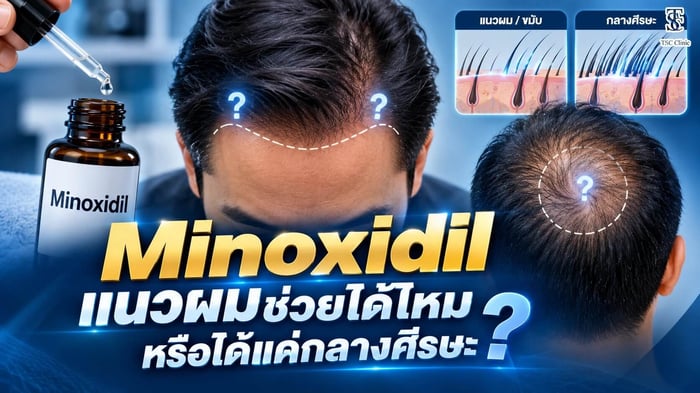 Minoxidil แนวผม ได้ผลไหม เปรียบเทียบกับการใช้บริเวณกลางศีรษะ