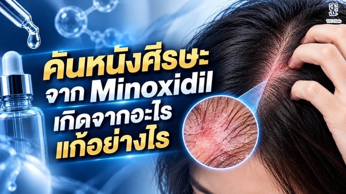 คันหนังศีรษะจาก Minoxidil เกิดจากอะไร แก้อย่างไร