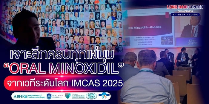 Minoxidil: สรุปทุกประเด็นสำคัญจากงานประชุม IMCAS 2025 ที่คนผมบางห้ามพลาด!