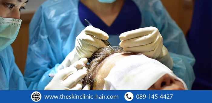 ตัวเลือกการปลูกผมถาวร สำหรับอาการศีรษะล้านในผู้ชาย