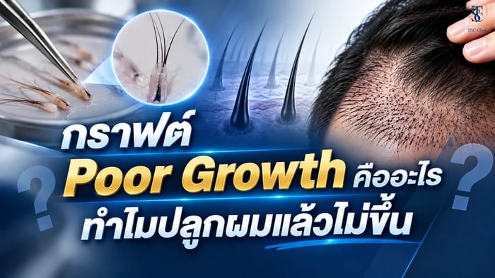 กราฟต์ Poor Growth คืออะไร ทำไมปลูกผมแล้วไม่ขึ้นทั้งที่ดูแลถูกวิธี