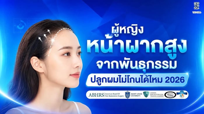 ผู้หญิงหน้าผากสูงจากพันธุกรรม ปลูกผมไม่โกนได้ไหม