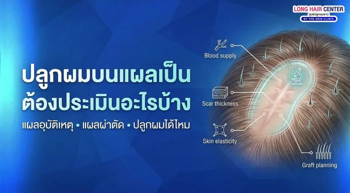 ปลูกผมบนแผลเป็นจากอุบัติเหตุหรือผ่าตัด ต้องประเมินอะไรบ้าง