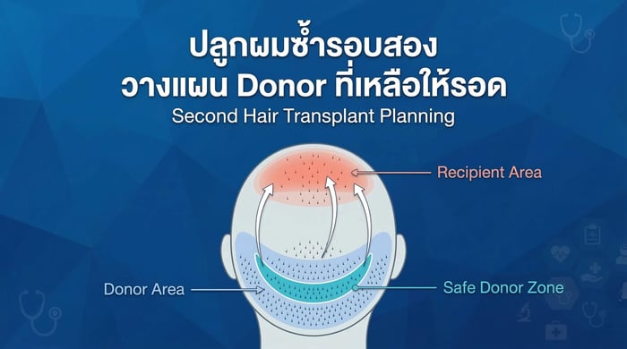 ปลูกผมซ้ำรอบสอง: วางแผน Donor ที่เหลือให้รอด