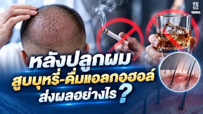 หลังปลูกผม สูบบุหรี่หรือดื่มแอลกอฮอล์มีผลอย่างไรต่อการรอดของกราฟต์