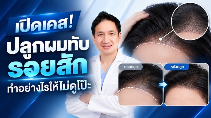 เปิดเคส! ปลูกผมทับรอยสัก ทำอย่างไรให้ไม่ดูโป๊ะ
