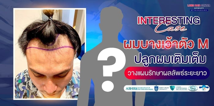 ผมบางเว้ารูปตัว M วางแผนรักษาปัญหาเส้นผมอย่างไรดี?