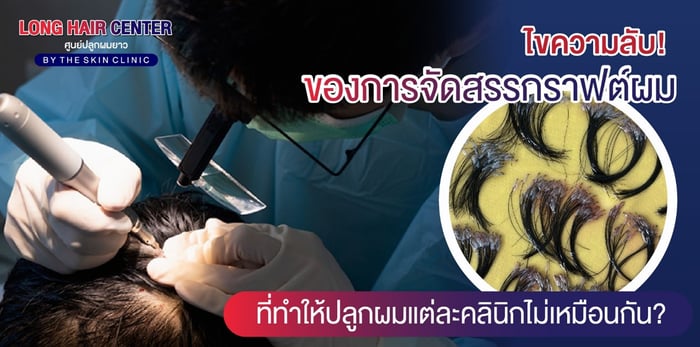 ไขความลับ! การจัดสรรกราฟต์ผม ที่ทำให้ปลูกผมแต่ละที่ไม่เหมือนกัน?