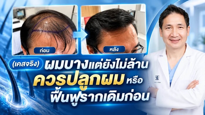 ผมบางแต่ยังไม่ล้าน ควรปลูกผมทับหรือฟื้นฟูรากเดิมด้วย ALMI Nano Fat