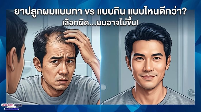 ยาปลูกผมแบบทา vs แบบกิน แบบไหนดีกว่า