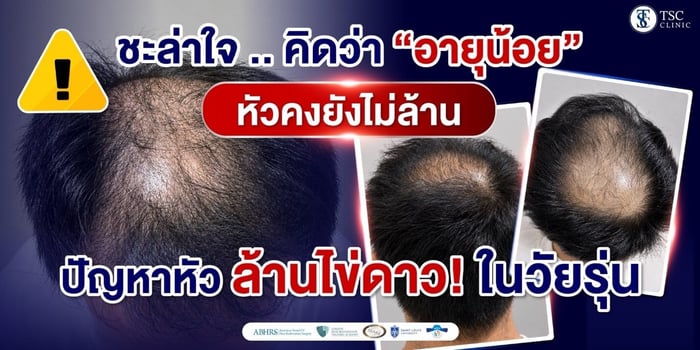 อย่าชะล่าใจ! อายุน้อยก็ “หัวล้านไข่ดาว” ได้ เช็กสัญญาณเตือนผมบางกลางศีรษะ