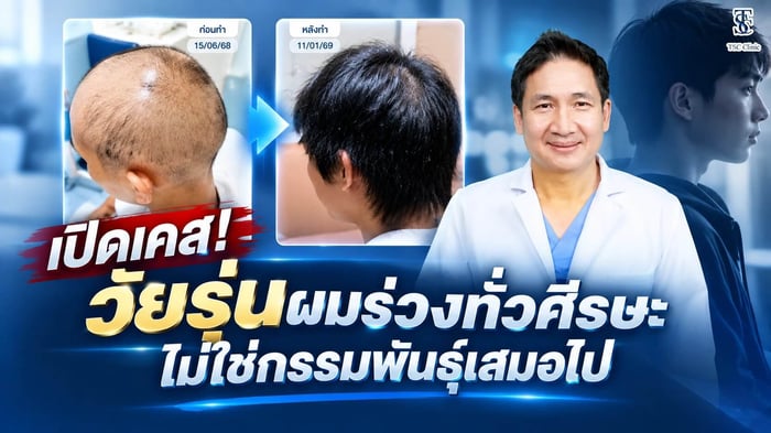 เปิดเคสจริง วัยรุ่นผมร่วงทั่วศีรษะ ตรวจพบโรค AA ไม่ใช่กรรมพันธุ์