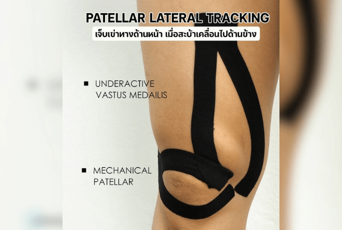 Patellar Lateral Tracking คืออะไร?