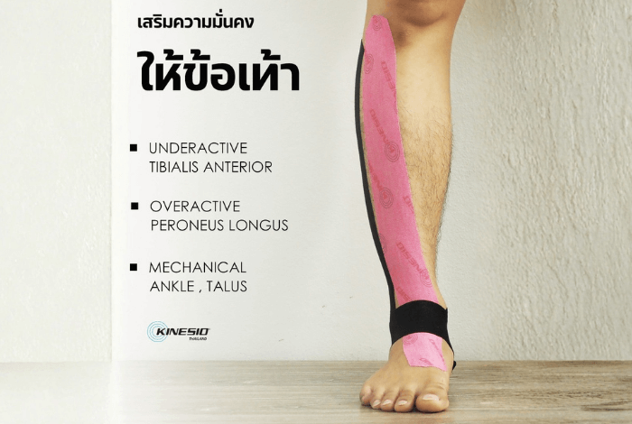 เสริมความมั่นคงให้ข้อเท้า (Ankle Stability) ด้วยคิเนซิโอเทป