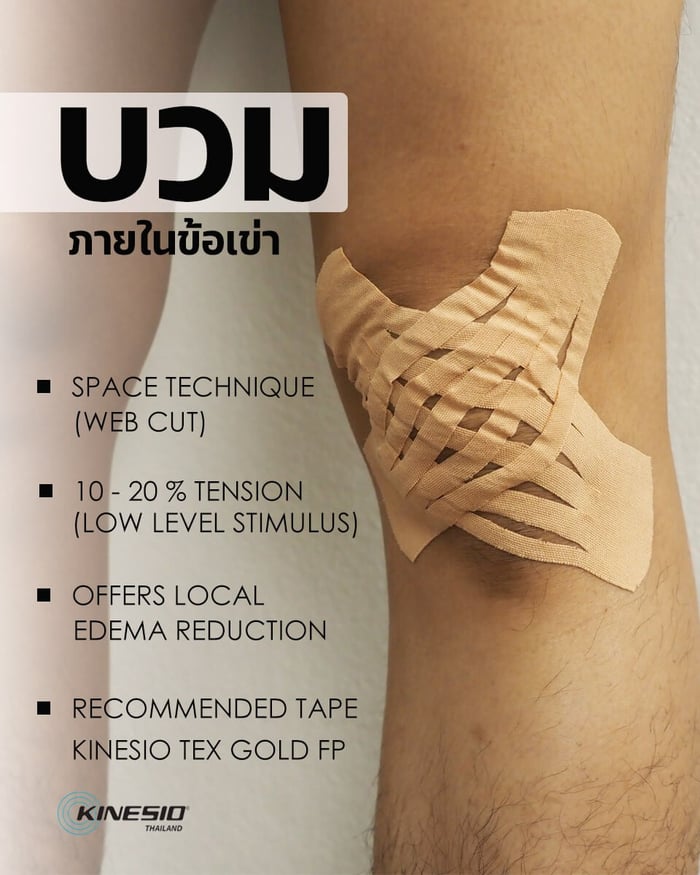 ภาวะเข่าบวมกับการใช้คิเนซิโอเทป