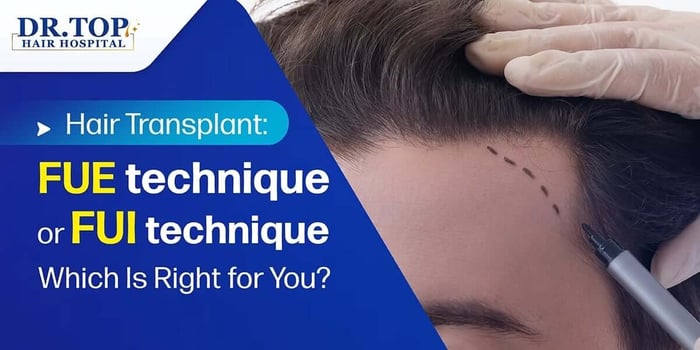 Hair Transplant: FUE technique or FUI technique Which Is Right for You?