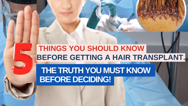 5 Things You Should Know Before Getting a Hair transplant