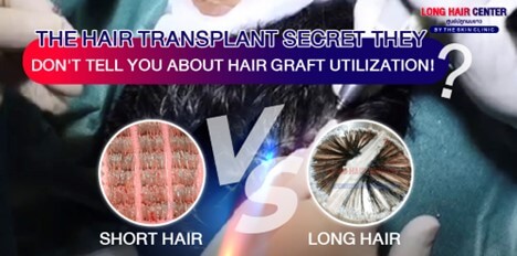 Are all extracted hair grafts suitable for transplantation?