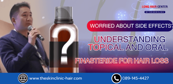 Are you torn between topical and oral Finasteride? Many people want to treat hair loss or thinning but are concerned about the possible side effects of taking Finasteride orally.