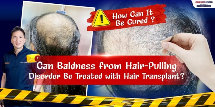 Can Baldness from Hair-Pulling Disorder