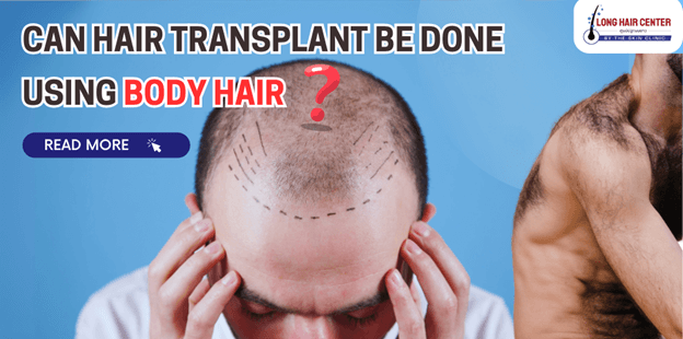 Can hair transplant be done using body hair?
