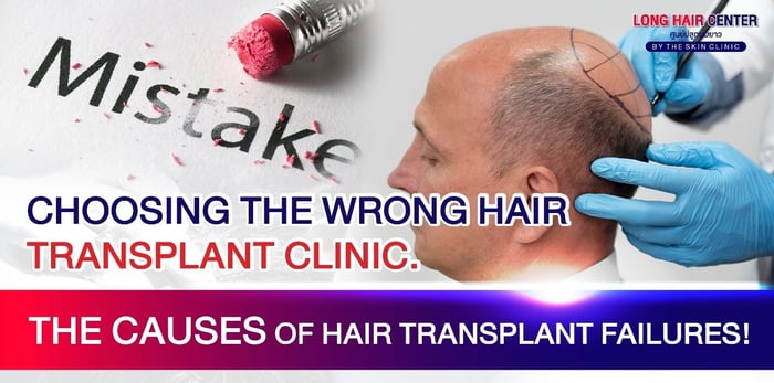 Choosing the Wrong Hair Transplant Clinic Can Change Your Life: The Causes of Major Hair Transplant Failures