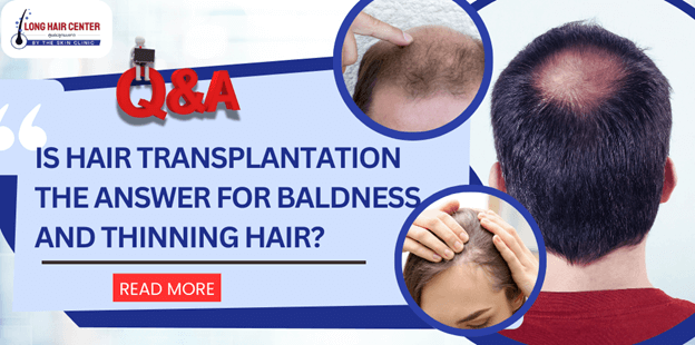 Is hair transplantation the answer for baldness and thinning hair?