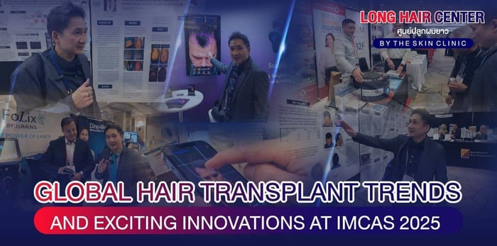 Global Hair Transplant Trends and Exciting Innovations at IMCAS 2025