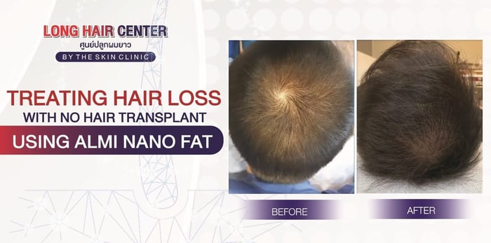 Hair Loss and Thinning Treatment Without Hair Transplant Using ALMI Nano Fat Technique