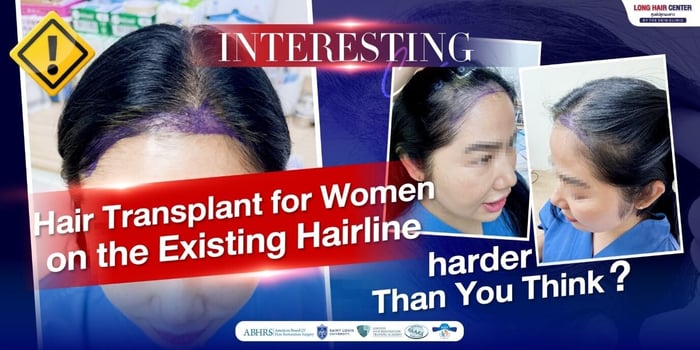 Hair Transplant for Women on the Existing Hairline, harder Than You Think
