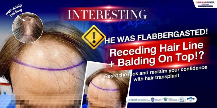 Hair Transplant in Thailand Review: German Patient’s with Long Hair FUI by Dr. Top Hair Hospital