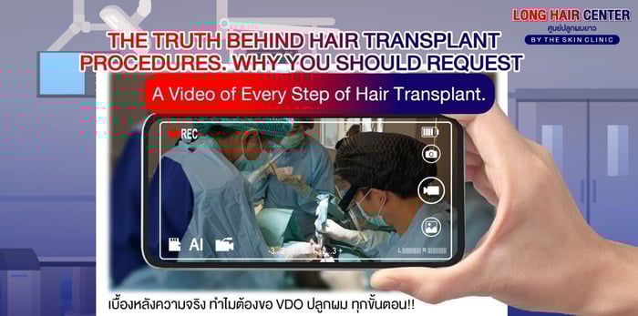 Why Ask for a Full Procedure Video Before Your Hair Transplant