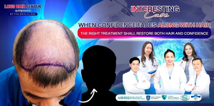 Hair Transplant for Men: Restoring Confidence with Short Hair & ALMI Nano Fat