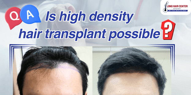 Is high density hair transplant possible?