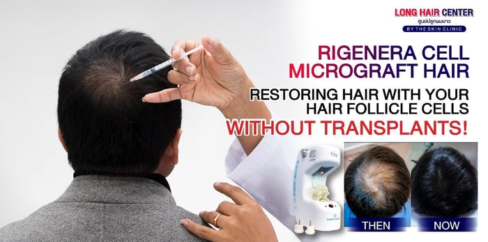 Rigenera Cell Micrograft Hair: Restoring Hair with Your Hair Follicle Cells Without Transplants