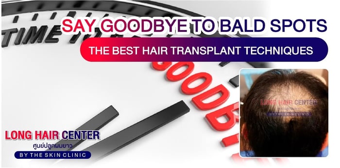 Say Goodbye to Bald Spots: The Best Hair Transplant Techniques