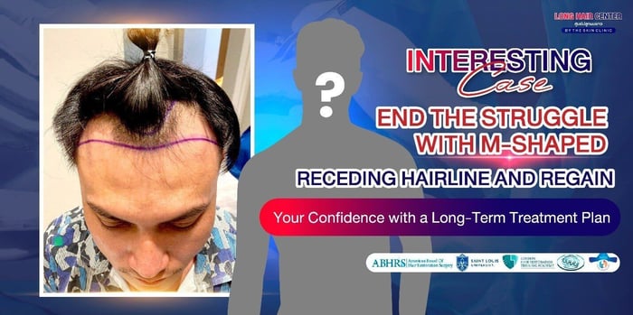 End M-Shaped Hairline Struggles with Long-Term Solutions