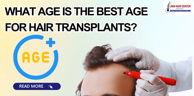 Can I get a hair transplant if I’m under 30s and what age is the best age for hair transplants?