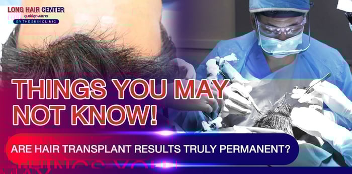 Things You May Not Know: How Long Does Permanent Hair Transplant Last? Will the Results Be Permanent?