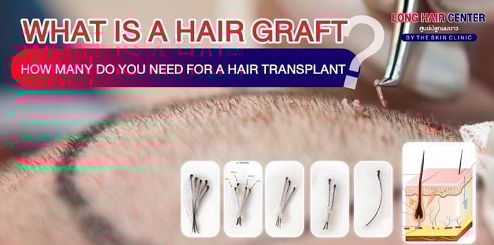 What is a Hair Graft? How Many Do You Need for a Hair Transplant?