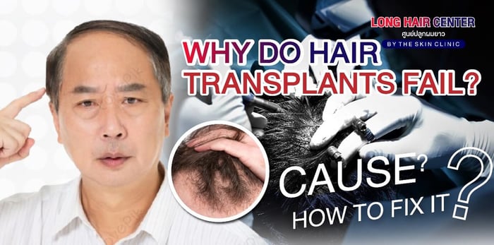 Why do hair transplants fail?