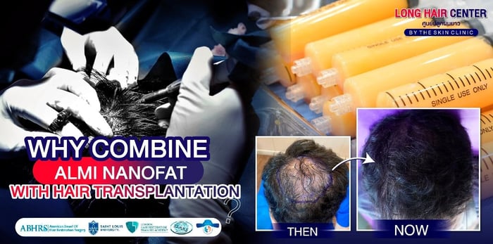 Why Combine ALMI Nanofat with Hair Transplantation