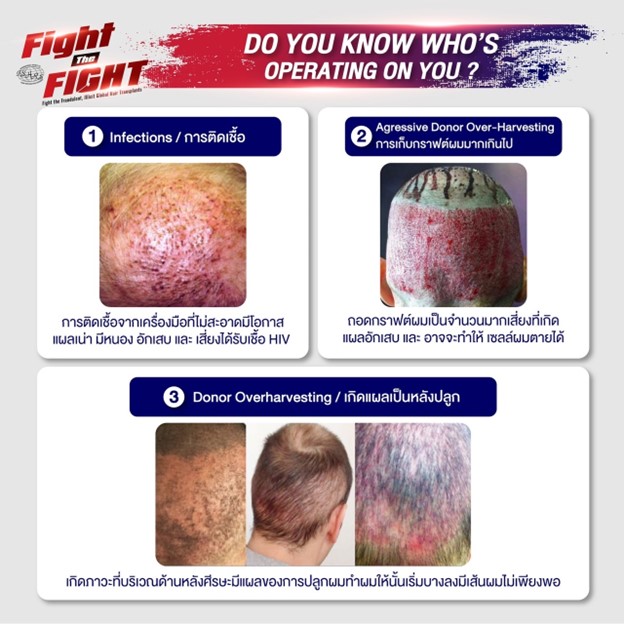 คลินิกปลูกผม, ปลูกผมที่ไหนดี