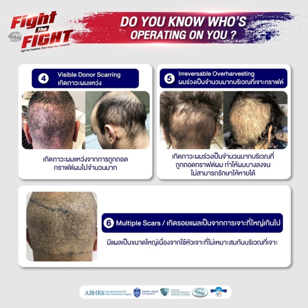 ศัลยกรรมปลูกผม, ปลูกผมที่ไหนดี