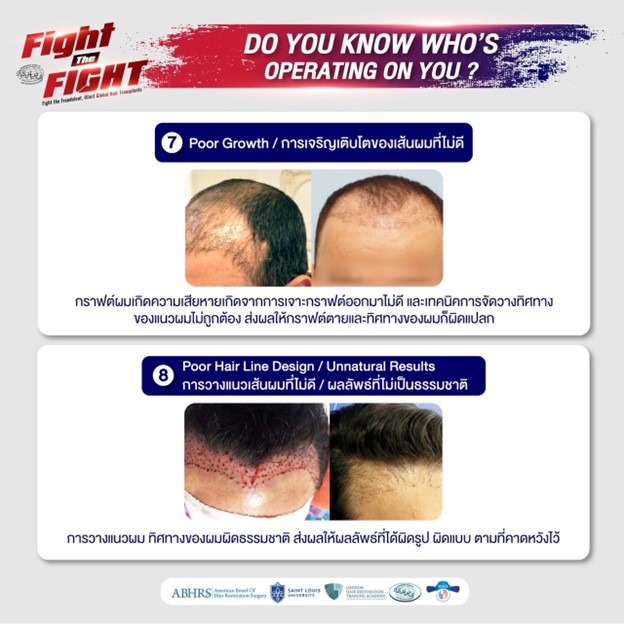 ศัลยกรรมปลูกผม, ปลูกผม FUE