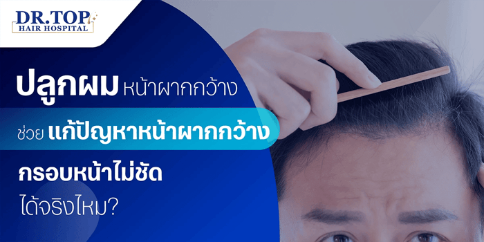 ปลูกผมหน้าผากกว้าง ช่วยแก้ปัญหาหน้าผากกว้าง กรอบหน้าไม่ชัด ได้จริงไหม?