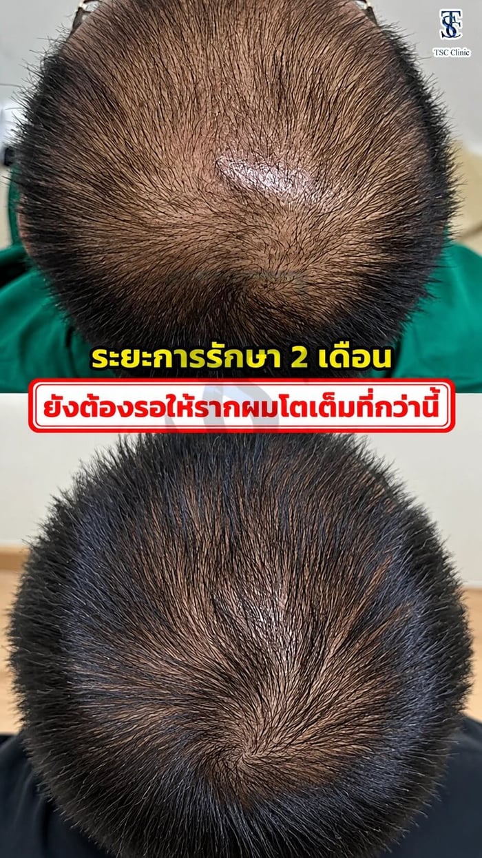 ผลลัพธ์เคสจริง หลังใช้ ALMI Nano Fat ฟื้นฟูผมบาง 3 จุด 2 เดือน